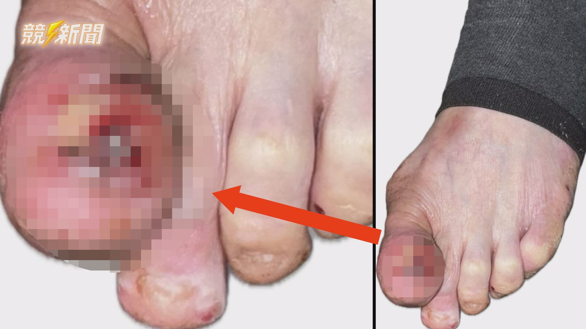 【衛生】腳趾紅腫一年不癒竟罹癌 高雄醫學大學附設中和紀念醫院揪出皮膚癌之冠